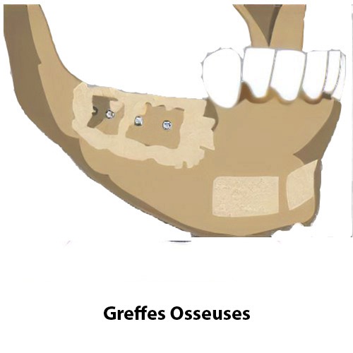 dentiste Langon Greffes osseuses