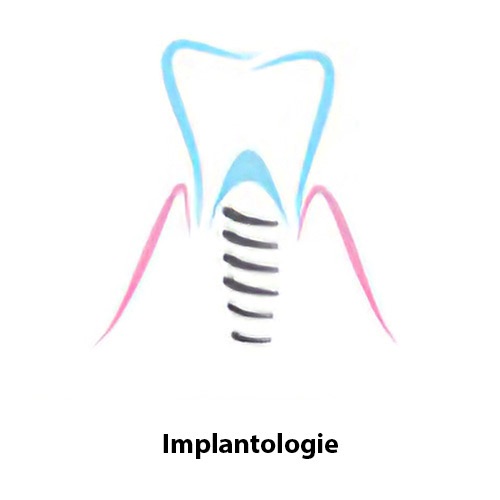 dentiste Langon Implantologie dentaire