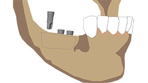 Greffes osseuses dentaires Langon 8