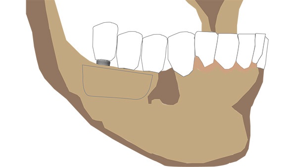 Greffes osseuses dentaires Langon 9