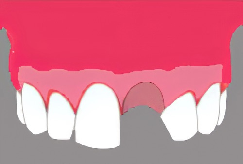 implants dentaires Langon Implantologie Landes 1