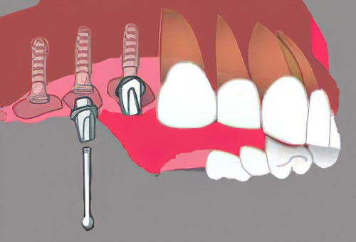 dentiste Langon implants dentaires 22