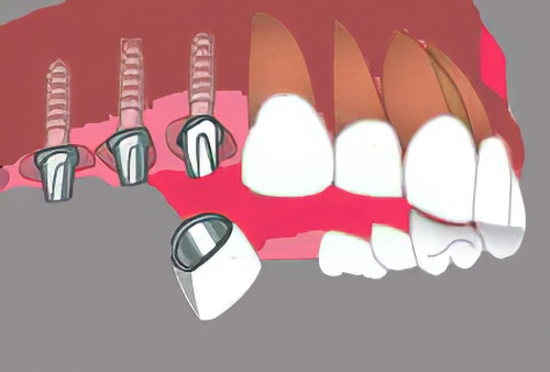 cabinet dentaire Langon implants dentaires 23