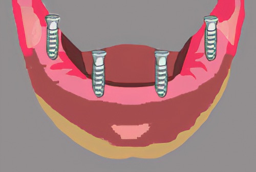 dentiste Langon implants dentaires 26