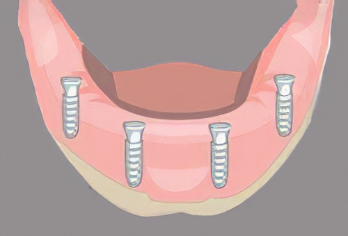 cabinet dentaire Langon implants dentaires 27