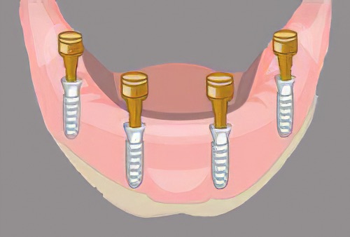 Denis CHAMONT HARO implants dentaires 28