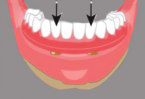 implants dentaires Langon 32