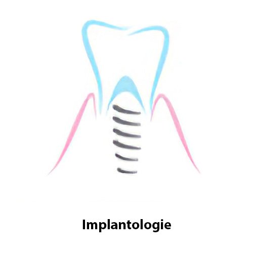 dentiste Langon Implantologie dentaire