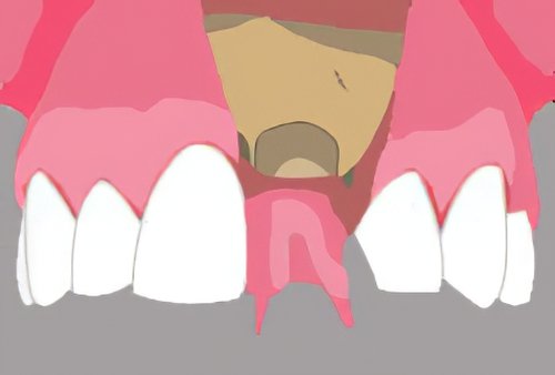 Implants dentaires Bazas