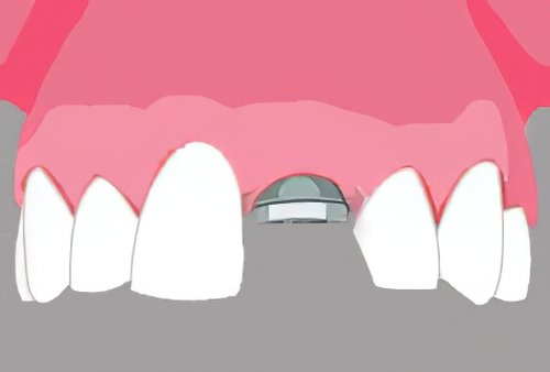 Implants dentaires Bazas_15