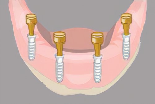Implants dentaires Langon