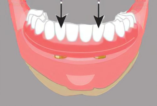 Implants dentaires Landes_32
